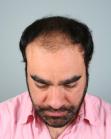 Before Hair Transplant&nbsp;2 Sessions (Areas)